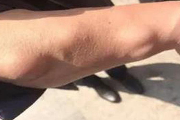 脂肪肉瘤胳膊侧面肿块图