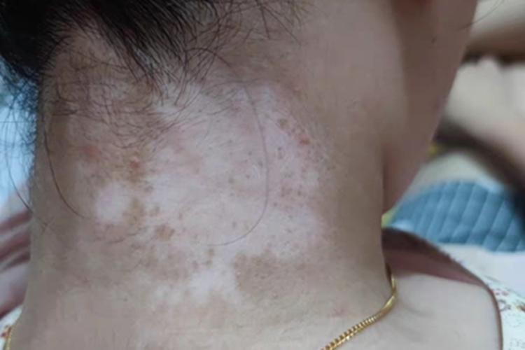 泛发型白癜风后颈白斑图