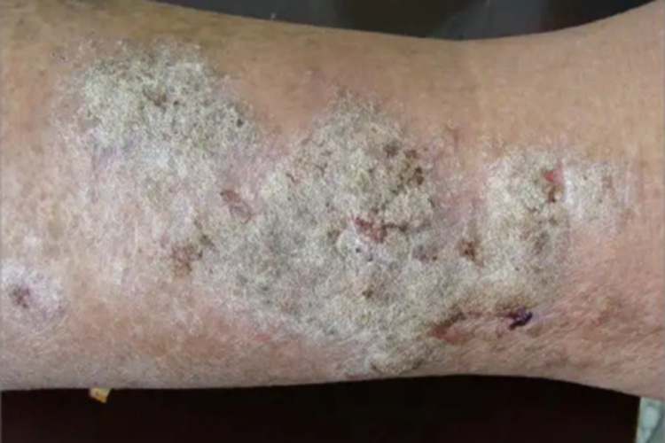 砷角化病小腿皮肤粗糙图