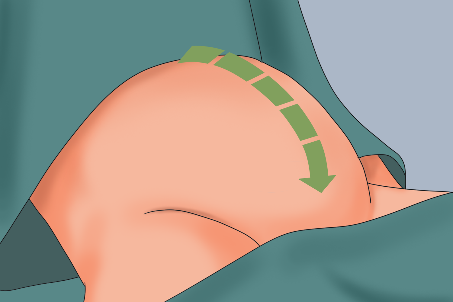 子宫体部剖宫产术切口图