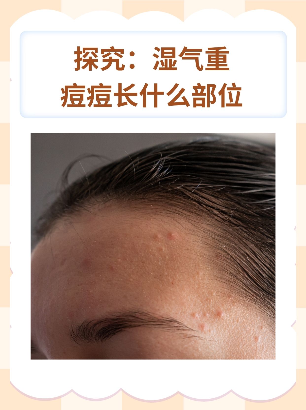 探究：湿气重痘痘长什么部位