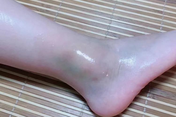 踝扭伤脚踝周围发青图