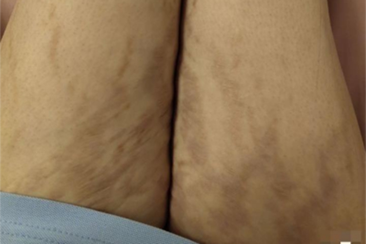 萎缩纹大腿根有褐色的线条图