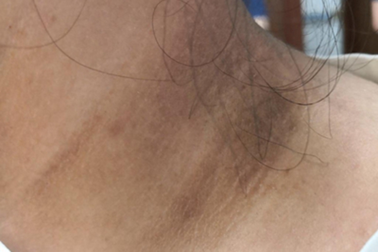 假性黑棘皮病颈部摸着粗糙图