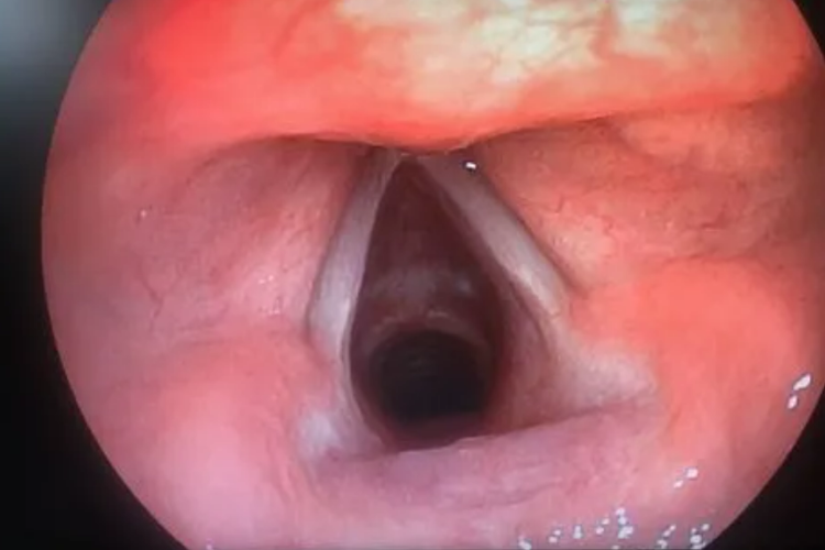 吃马蜂过敏喉水肿图