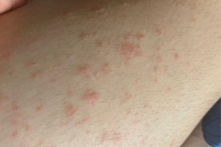 运动诱导性荨麻疹大腿丘疹图