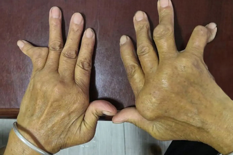 类风湿关节炎类风湿结节图