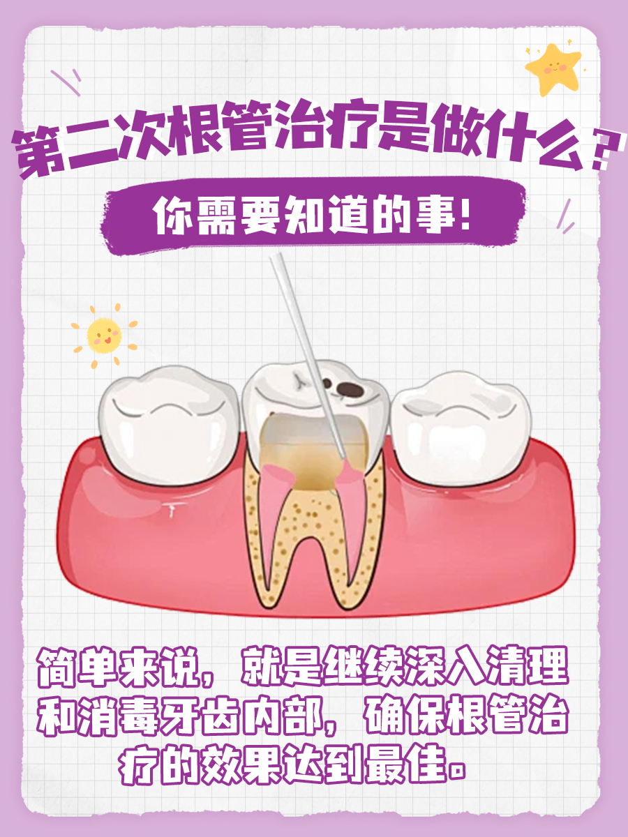 第二次根管治疗是做什么？你需要知道的事！