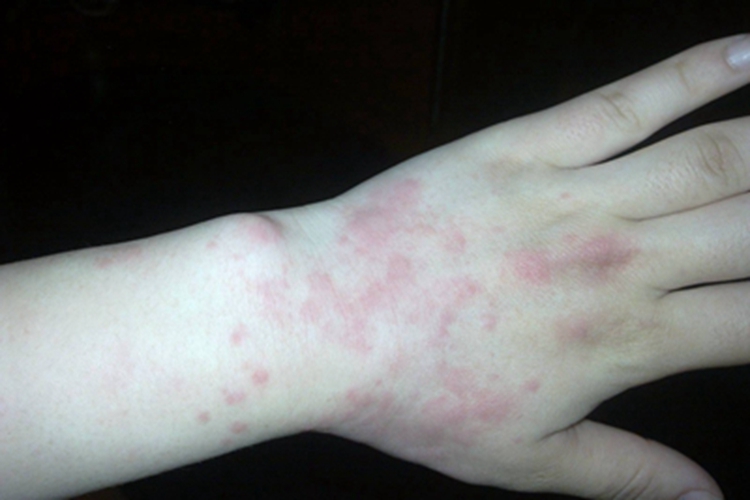 茶毛虫皮炎手背有红斑图
