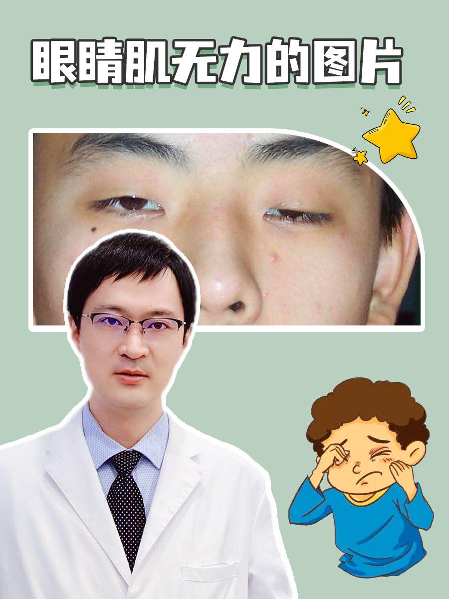 眼睛肌无力的图片