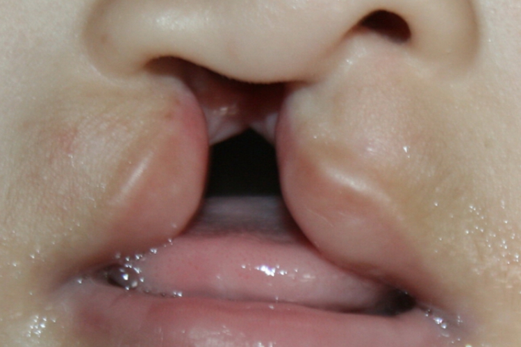 儿童Ⅲ度唇裂图 儿童Ⅲ度唇裂图