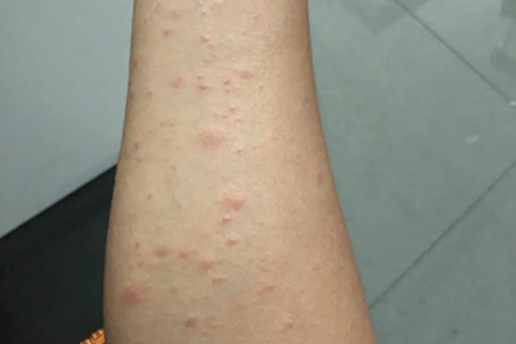 淋巴瘤样丘疹病胳膊丘疹图 淋巴瘤样丘疹病胳膊丘疹图