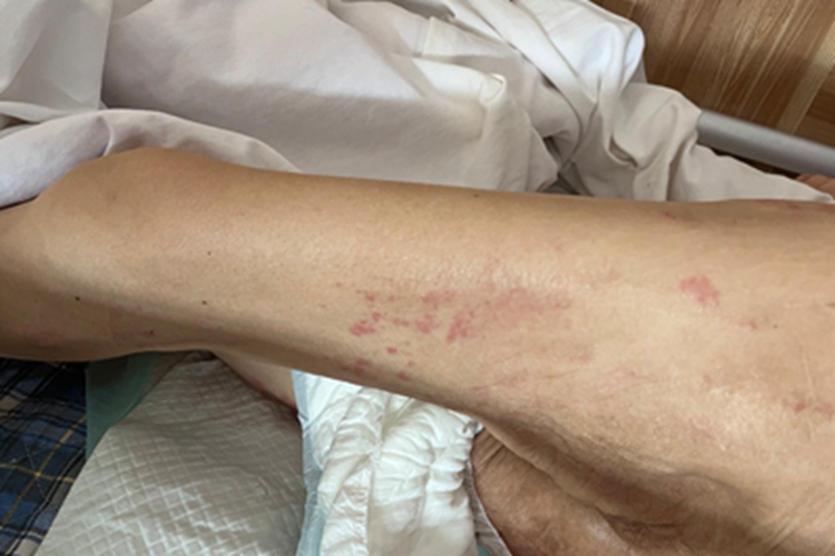 接触性皮炎大腿症状图 接触性皮炎大腿症状图