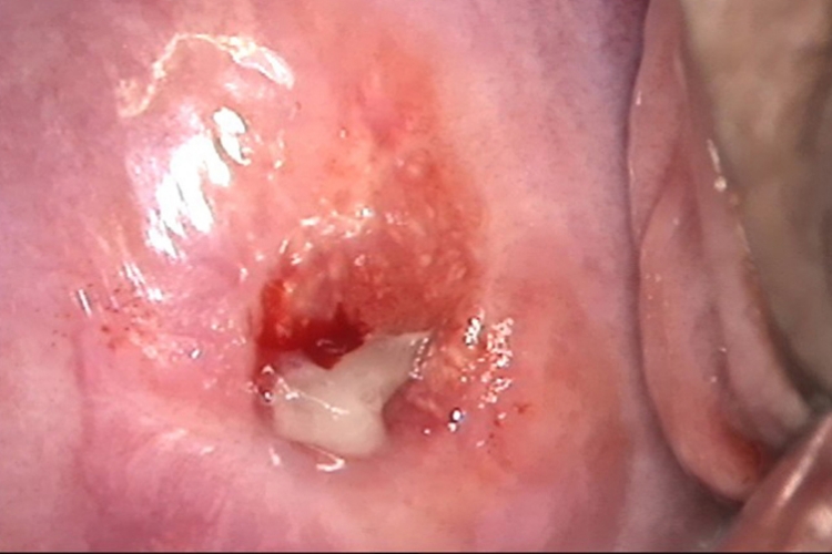 女性生殖道衣原体感染图