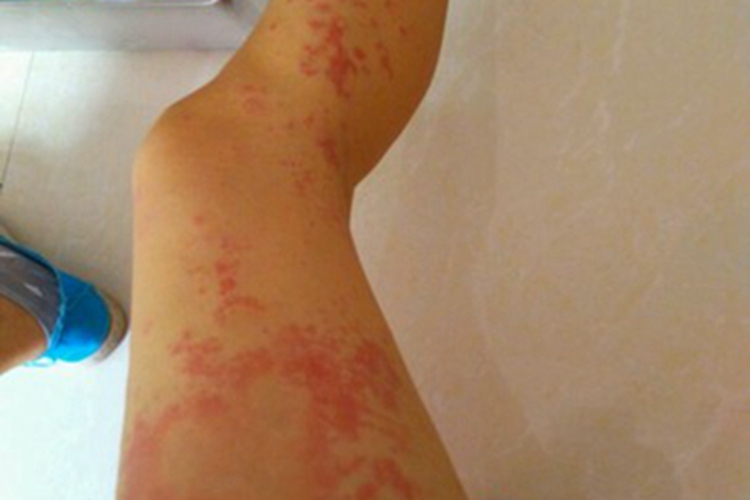 荨麻疹型药疹红斑图 荨麻疹型药疹红斑图