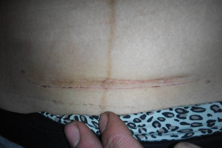 剖宫产2-3周刀口图