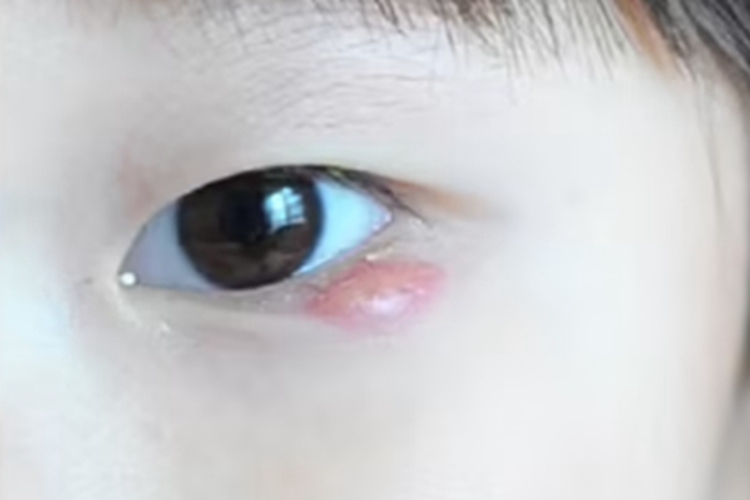 外睑腺炎脓包图 外睑腺炎脓包图