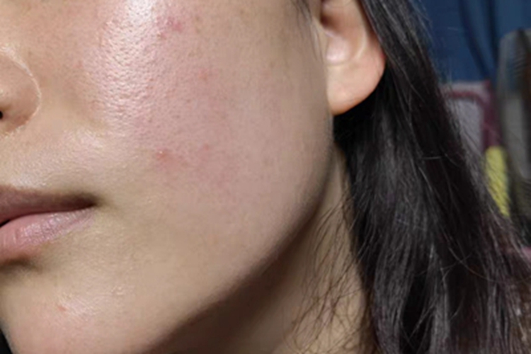 痤疮脸上起几个小红疙瘩图 痤疮脸上起几个小红疙瘩图