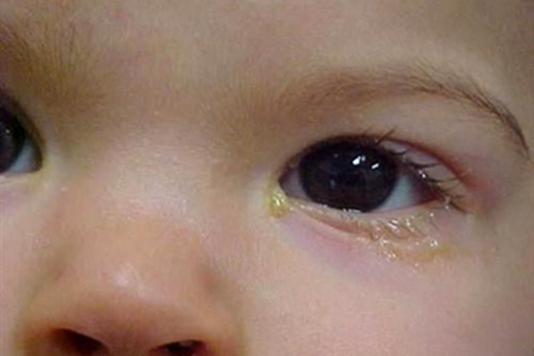 急性泪囊炎眼睑分泌物图