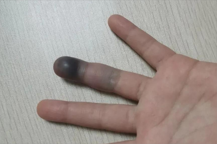 夹伤手指皮肤颜色加深图