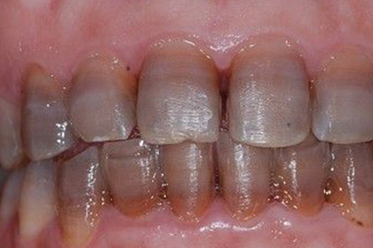 极重度四环素着色灰褐色图