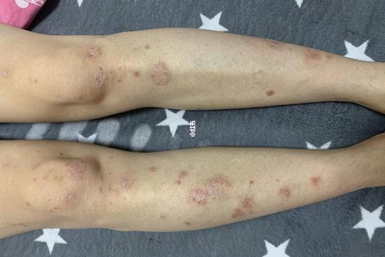 小腿寻常型银屑病图
