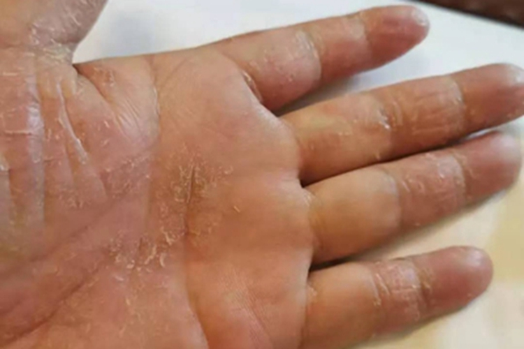 手部湿疹手掌有裂纹脱皮图 手部湿疹手掌有裂纹脱皮图