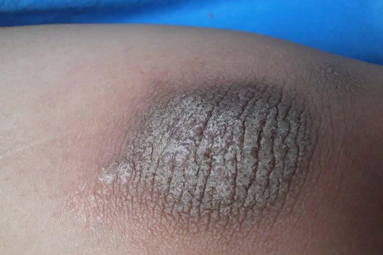 摩擦黑变病图 摩擦黑变病图