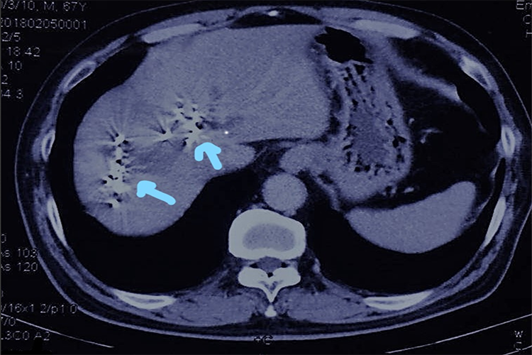 肾癌血行转移至肝图