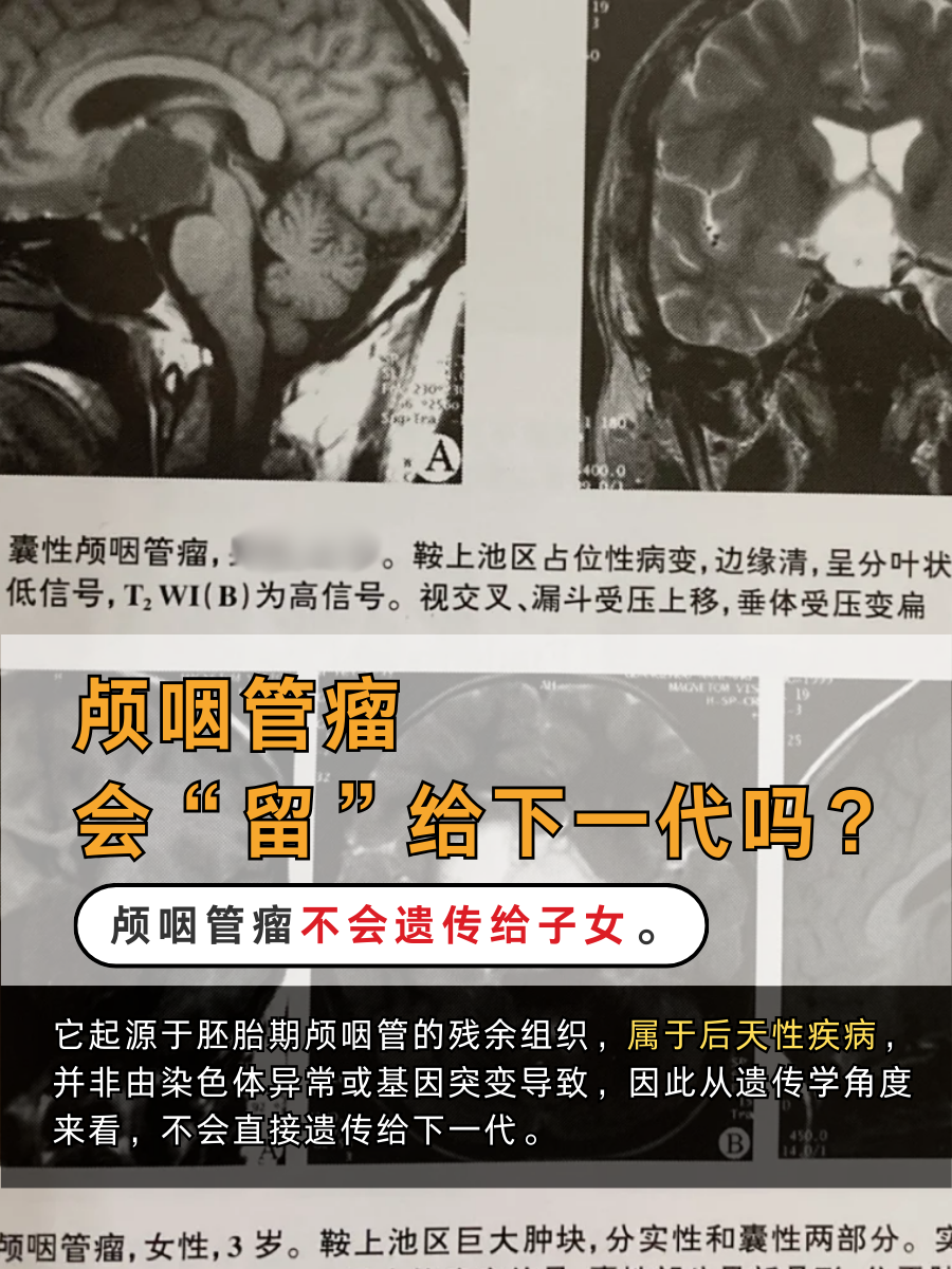 颅咽管瘤,会“留”给下一代吗?