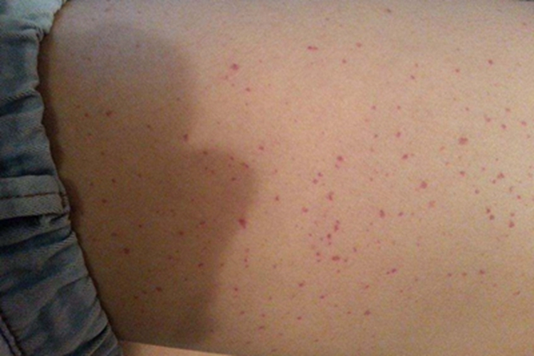 过敏性紫癜胳膊有紫斑图