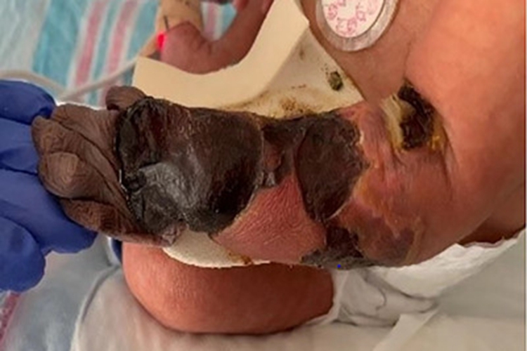 坏疽性蜂窝织炎手部症状图 坏疽性蜂窝织炎手部症状图