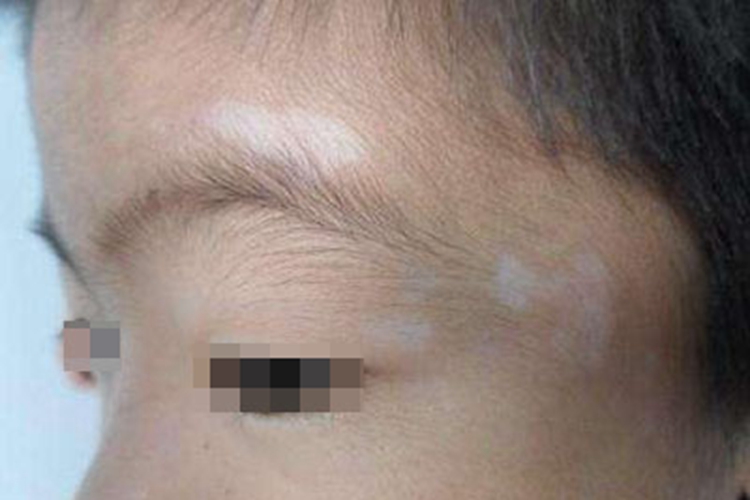 白色糠疹眉毛白斑图 白色糠疹眉毛白斑图