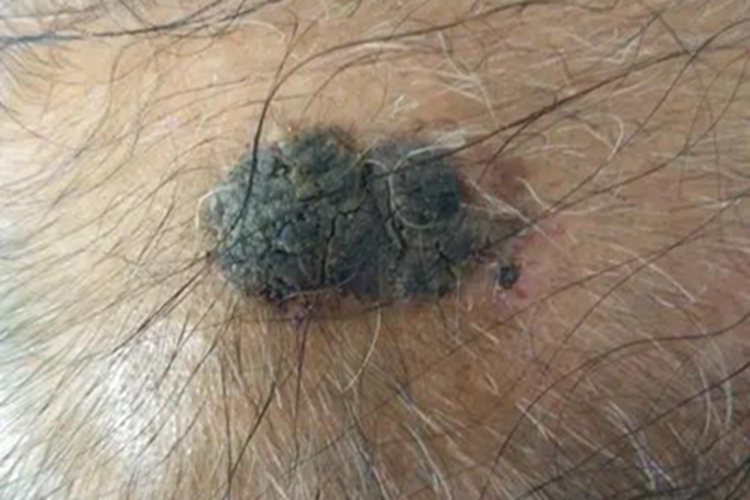 脂溢性角化病斑块图 脂溢性角化病斑块图