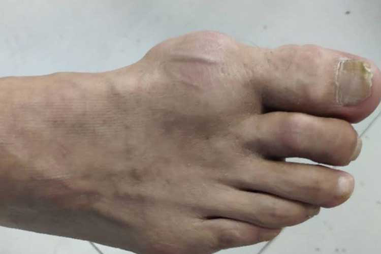 痛风患者急性关节炎期第1跖趾关节红肿图