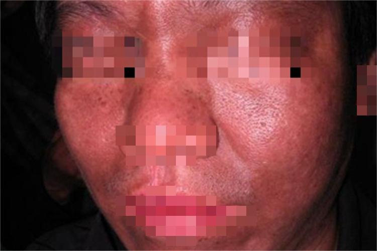 皮肤黑变病面部皮肤发黑图 皮肤黑变病面部皮肤发黑图