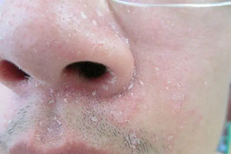 糖皮质激素依赖性皮炎鼻部脱屑图