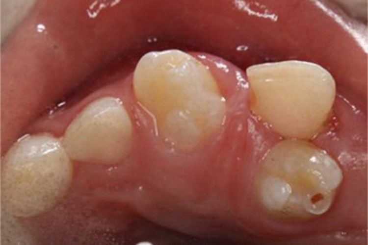 多生牙牙齿畸形图