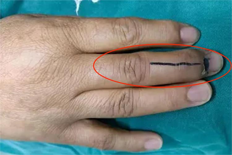 右手中指肌腱断裂肿胀图 右手中指肌腱断裂肿胀图