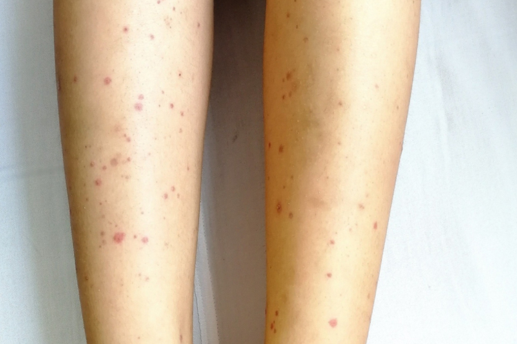 下肢过敏性紫癜图