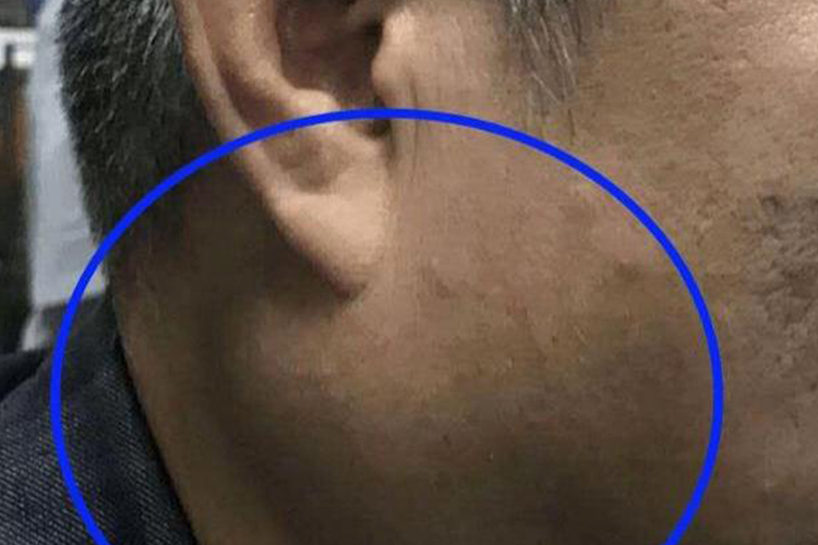 多形性腺瘤肿大腮图