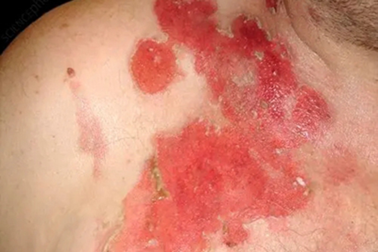 副肿瘤性天疱疮肩部糜烂图