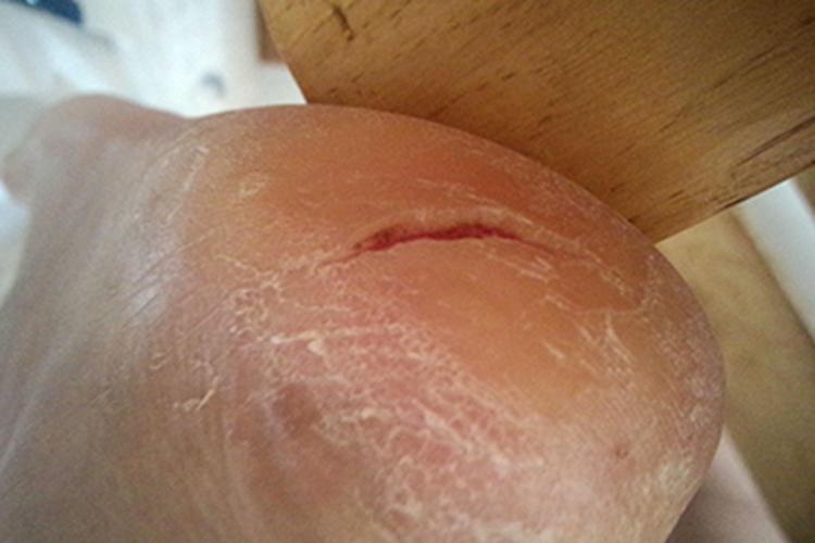 脚部皲裂裂开一条缝图