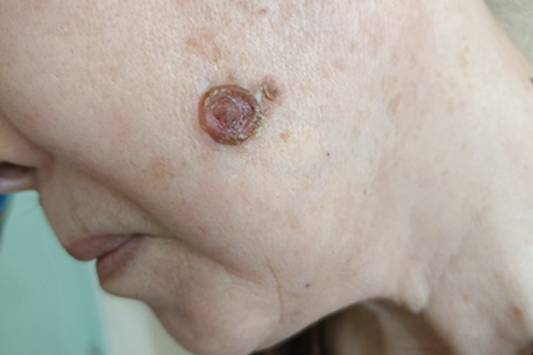 结节型基底细胞癌面部结节图