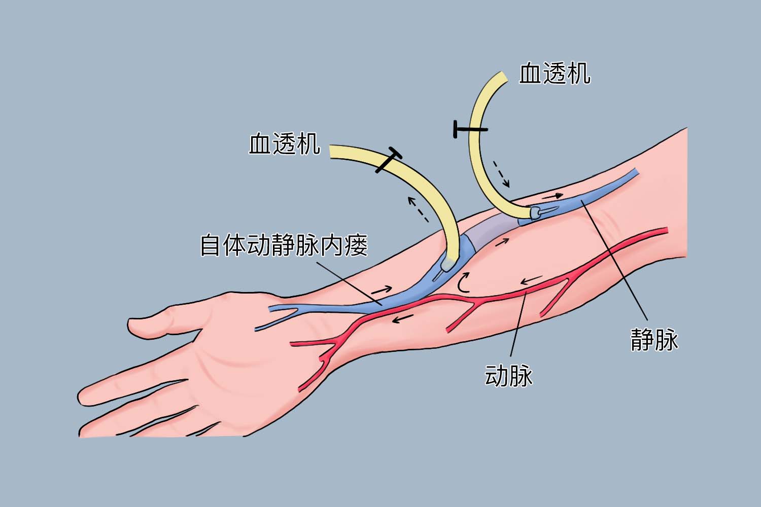 自身动静脉内瘘图