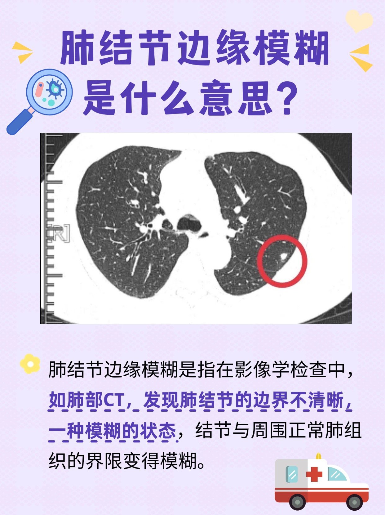 讲解：肺结节边缘模糊的意思