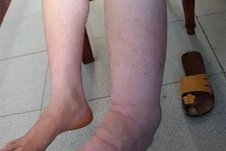 丝虫性淋巴水肿小腿变形图