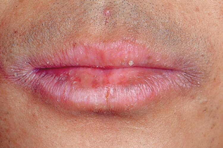 唇扁平苔癣口周皮肤粗糙图