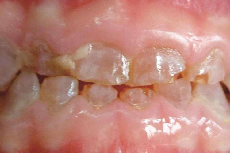 遗传性乳光牙本质图