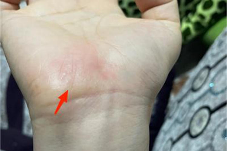 汗疱疹手掌症状图 汗疱疹手掌症状图